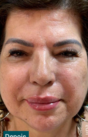 Antes e Depois Harmonização Facial - Studio Una