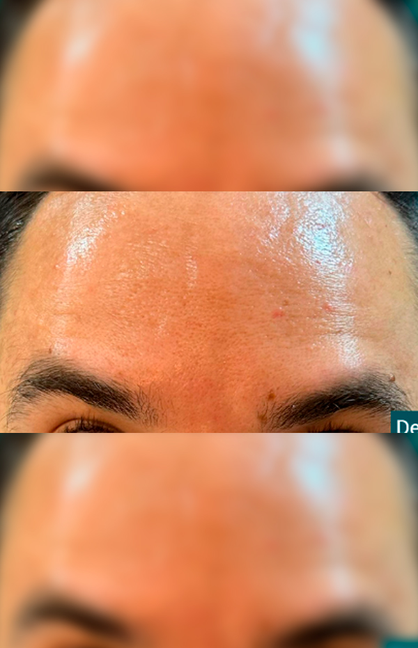 Antes e Depois Toxina Botulínica - Studio Una