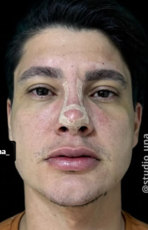 Antes e Depois Harmonização Facial - Studio Una