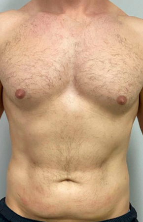 Antes e Depois Endolaser - Studio Una