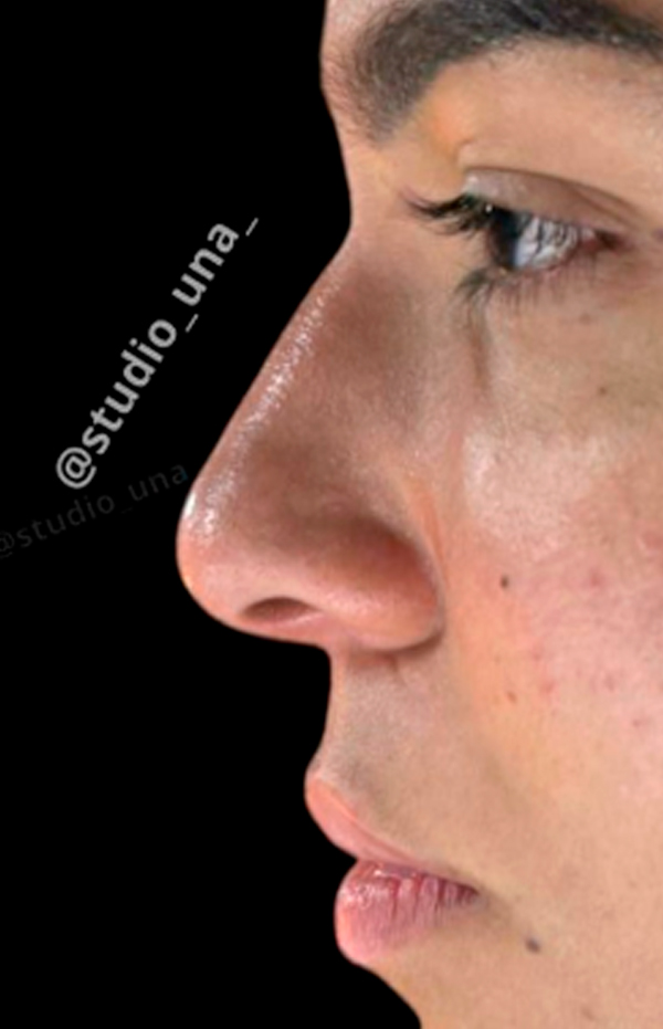 Antes e Depois Rinomodelação - Studio Una