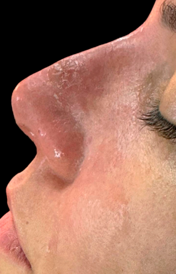 Antes e Depois Rinomodelação - Studio Una