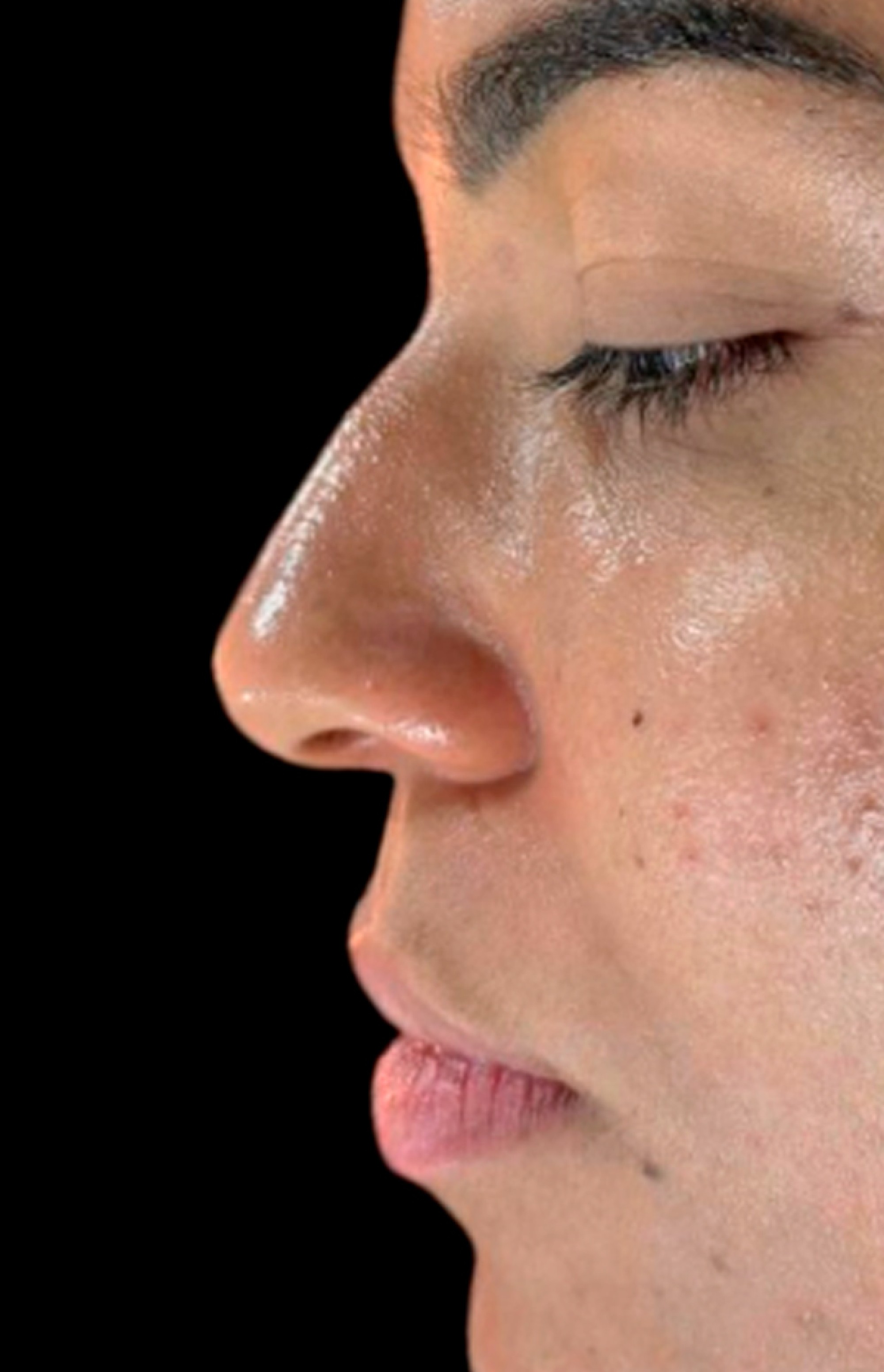 Antes e Depois Rinomodelação - Studio Una