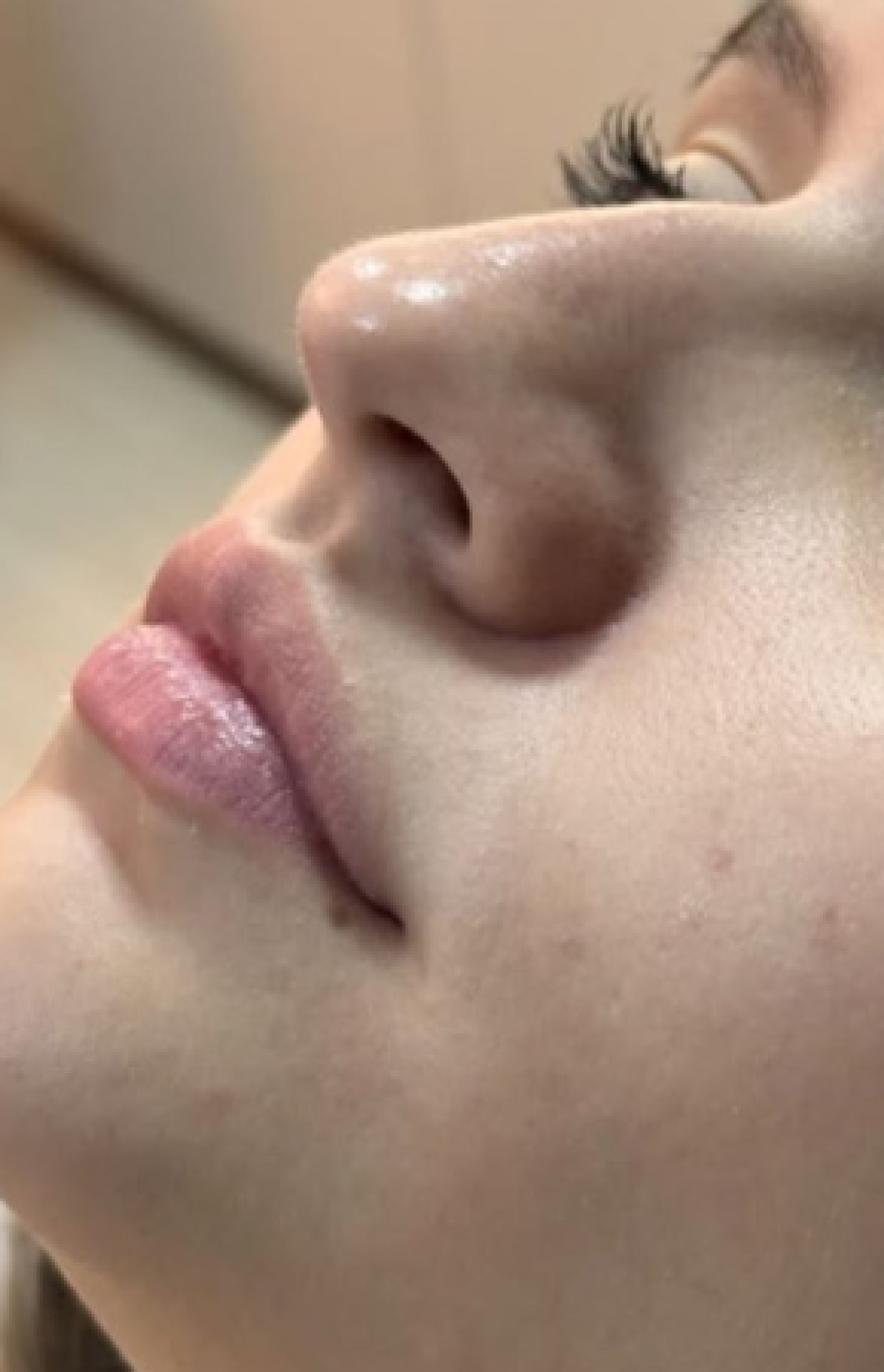 Antes e Depois Harmonização Facial - Studio Una