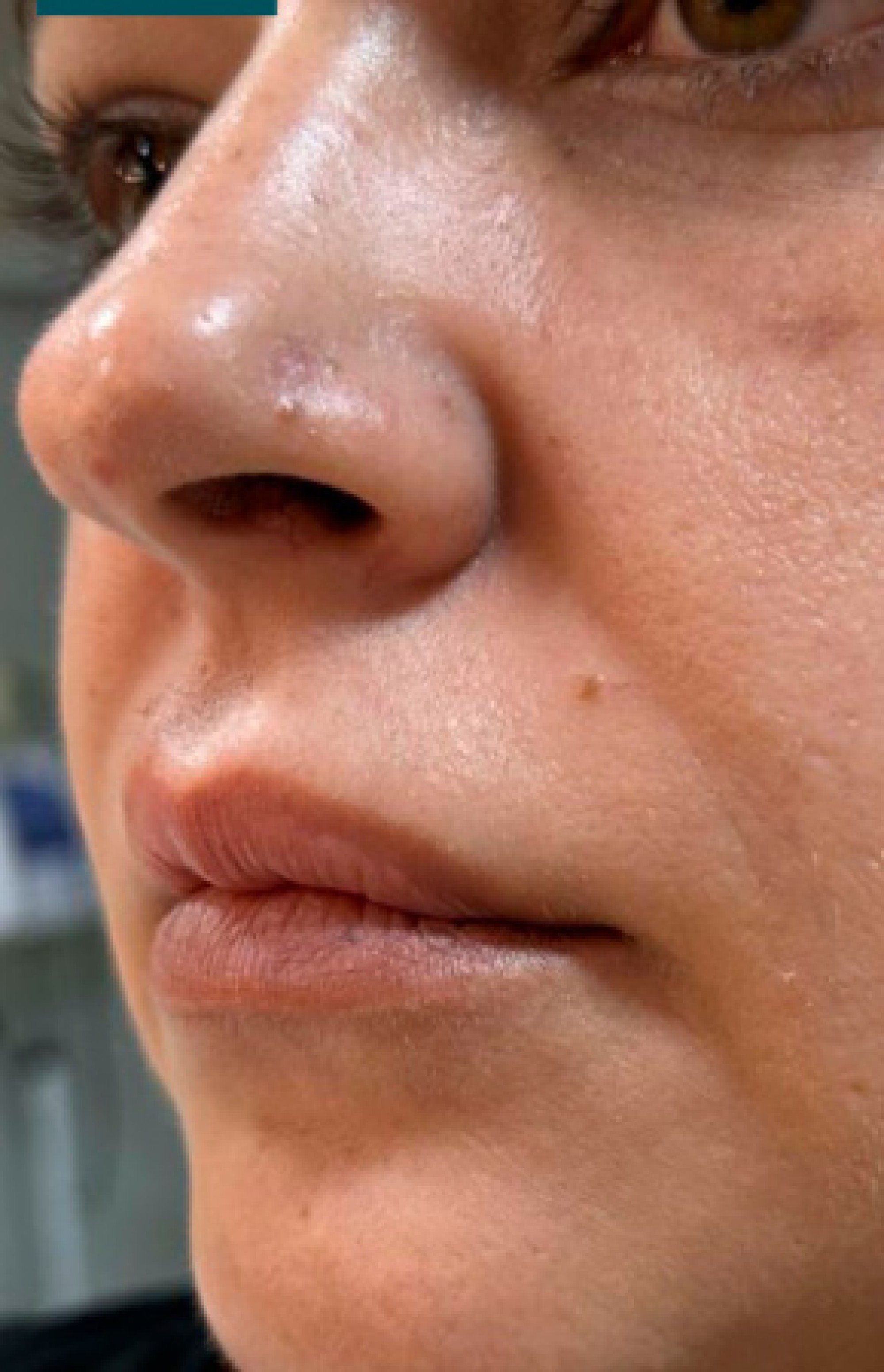 Antes e Depois Preenchimento Labial e Projeção do Queixo - Studio Una