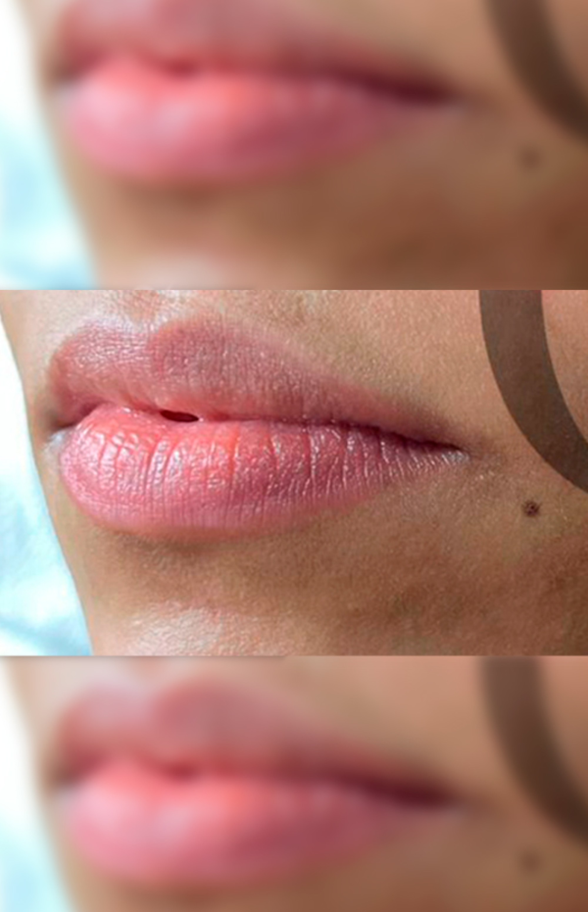 Antes e Depois Preenchimento Labial - Studio Una