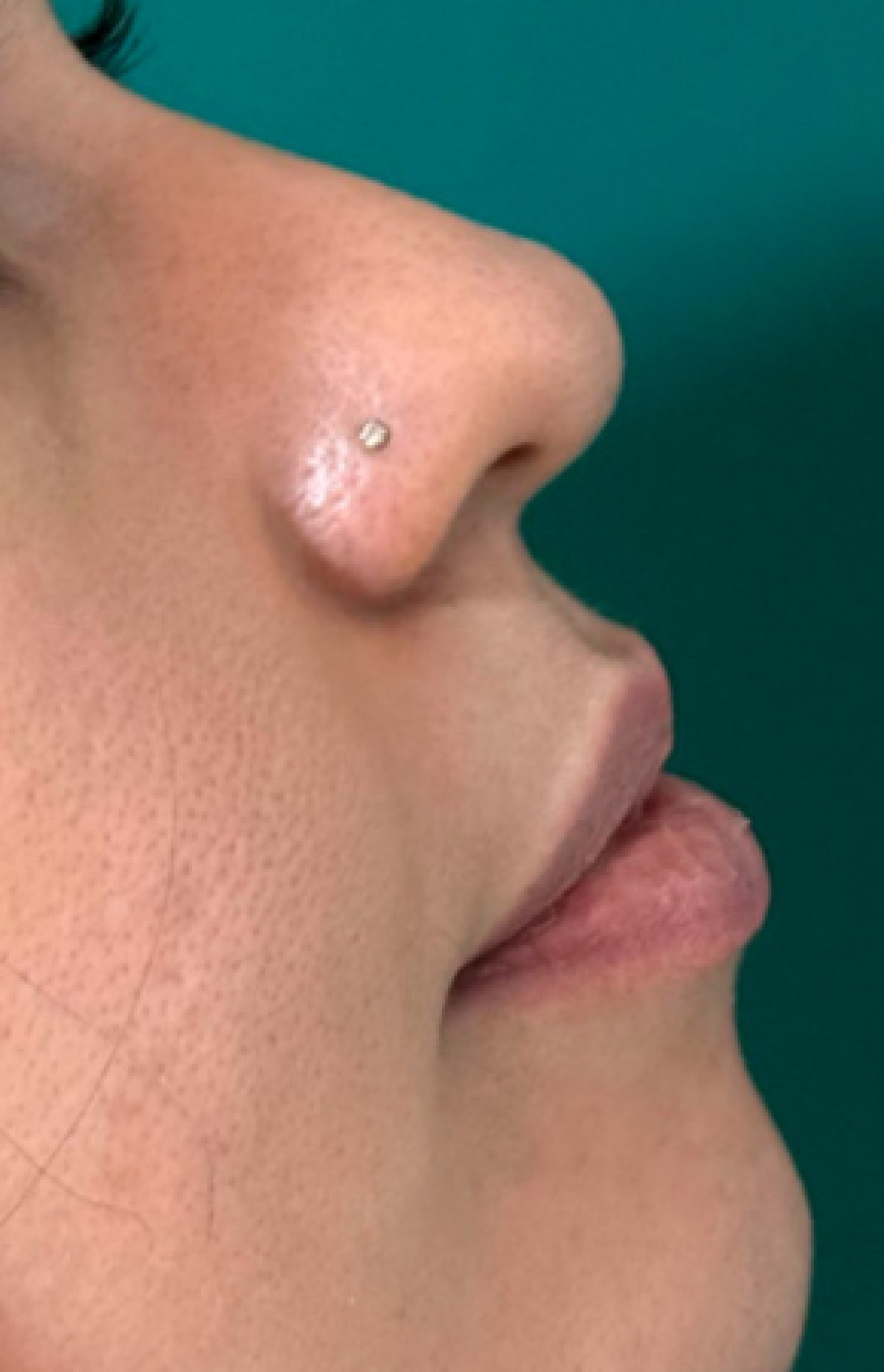 Antes e Depois Lábios, Rinomodelação e Mento - Studio Una