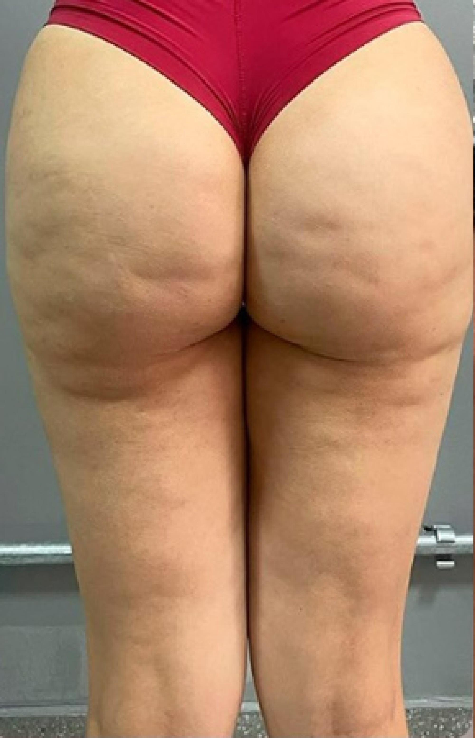 Antes e Depois Endolaser - Studio Una