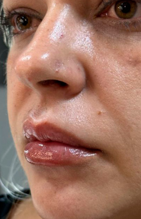 Antes e Depois Preenchimento Labial e Projeção do Queixo - Studio Una